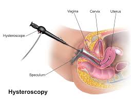 هیستروسکوپی - hysteroscopy